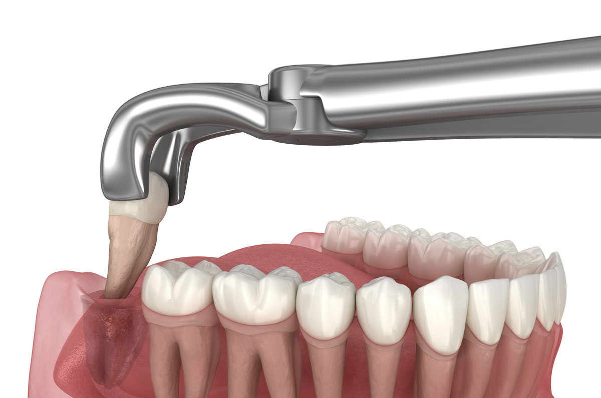 Tooth Extraction